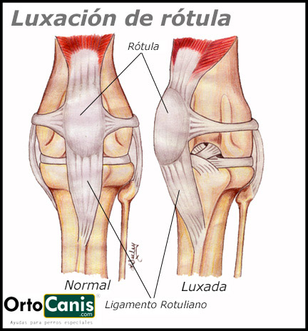 Luxación-de-rotula