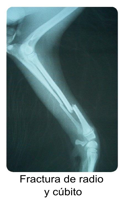 Radial and ulnar fracture