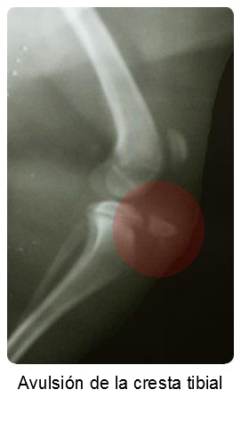 avulsion des tibia-kamms