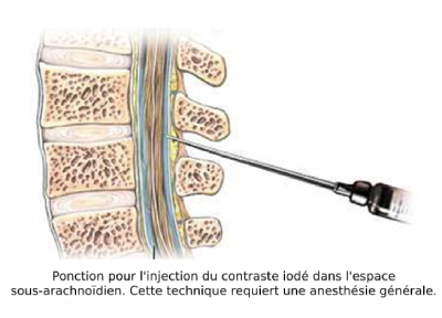 Ponction moelle épinière contraste iodé