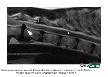 Résonance magnétique de hernie discale