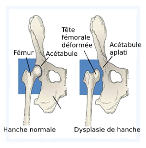 Dysplasie de la hanche