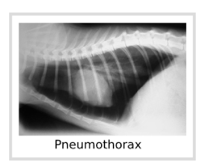 Pneumothorax