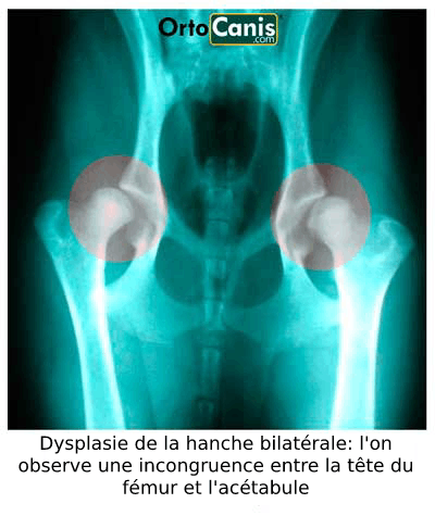 Dysplasie bilatérale de la hanche