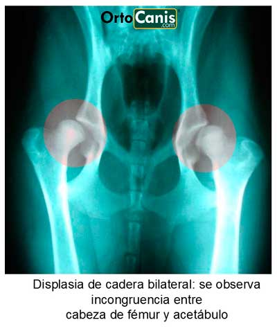 hip dysplasia