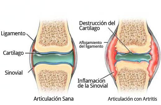 destruction of cartilage