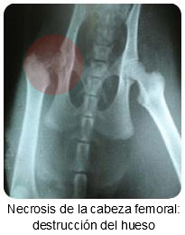 Necrosis avasular de la cabeza del fémur