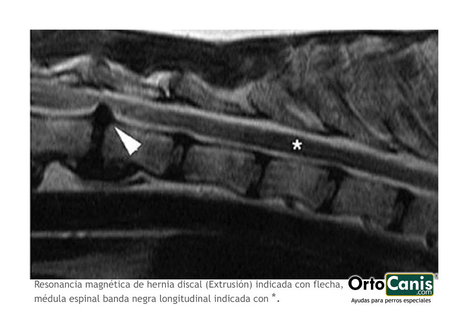 resonancia megnética hernia discal